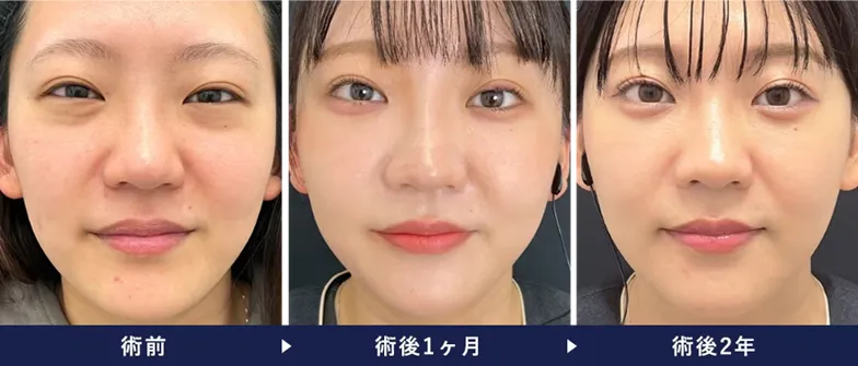 湘南美容クリニックの裏ハムラ法の名医　症例写真①