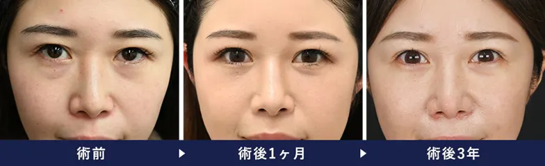 湘南美容クリニックの裏ハムラ法の　名医　症例写真②