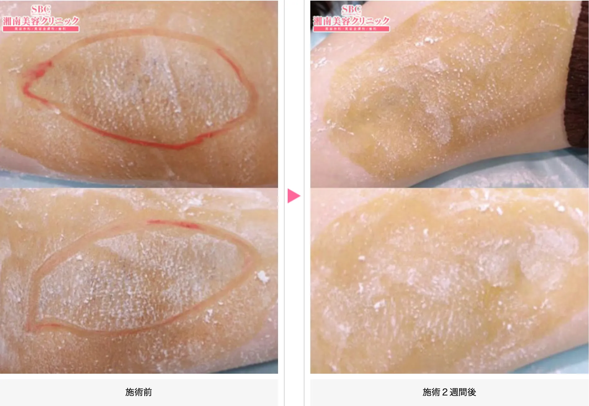 湘南美容クリニックの脇ボトックスの症例