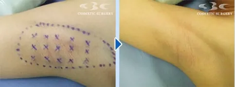 湘南美容クリニックの脇ボトックスの症例