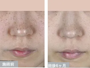 湘南美容クリニックのシミ取り治療の症例