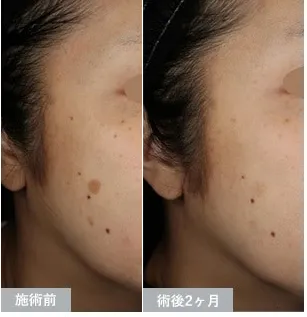 湘南美容クリニックのシミ取り治療の症例
