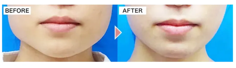 TCBのエラボトックスの症例