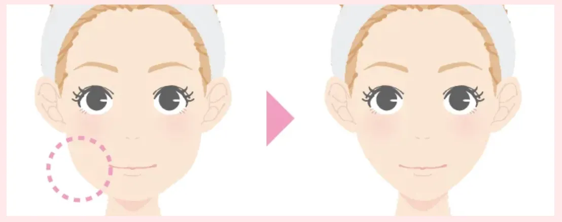 エラボトックス注射による変化