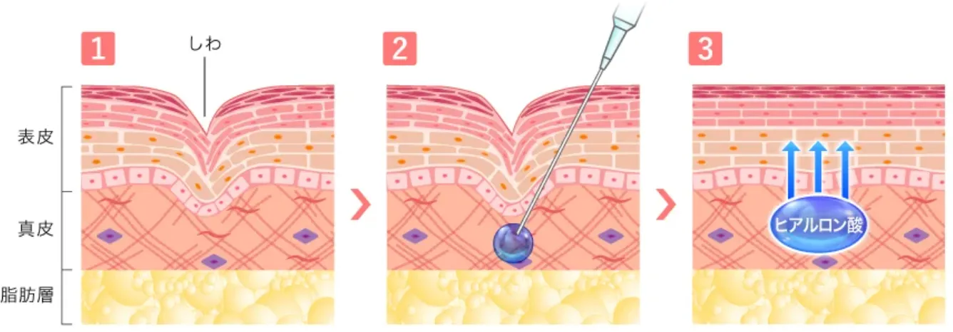 仙台でヒアルロン酸注射が受けられるおすすめのクリニック　TCB のヒアルロン酸注射についての説明