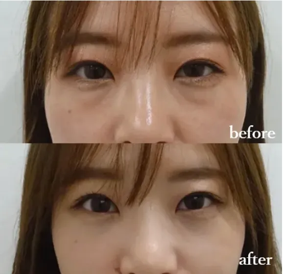 仙台でヒアルロン酸注射が受けられるおすすめのクリニック　TCB のヒアルロン酸注射の症例写真