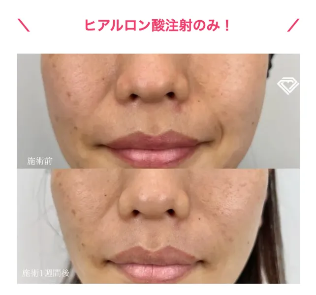 仙台でヒアルロン酸注射が受けられるおすすめのクリニック　TCB のヒアルロン酸注射の症例写真