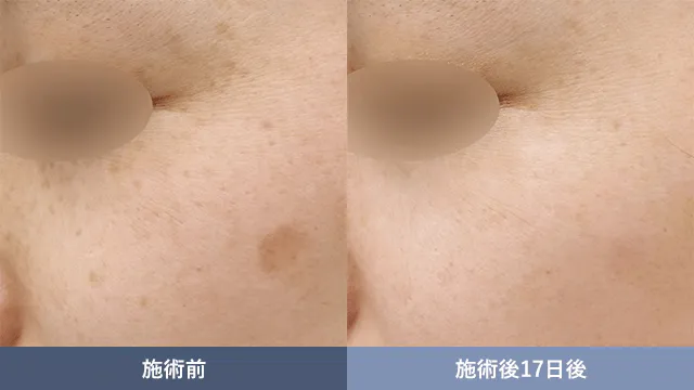 SBCのシミ取りの症例