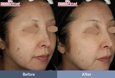 SBCのシミ取りの症例