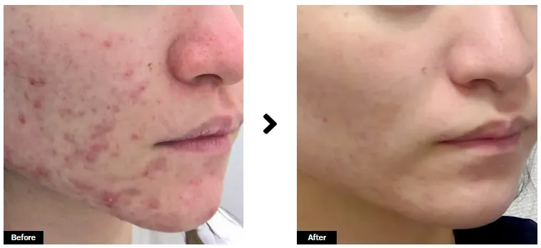 新宿美容外科クリニック新宿院のダーマペンの口コミ評判・症例写真　