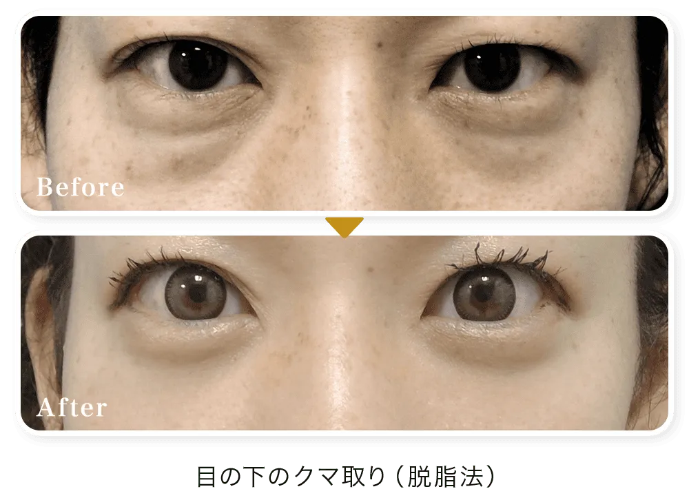 新宿美容外科クリニック新宿院のクマ取りの口コミ評判・症例写真　