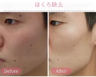 新宿美容外科クリニック新宿院のほくろ除去の口コミ評判・症例写真　