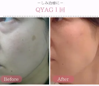 新宿美容外科クリニック新宿院のシミ取りの口コミ評判・症例写真　