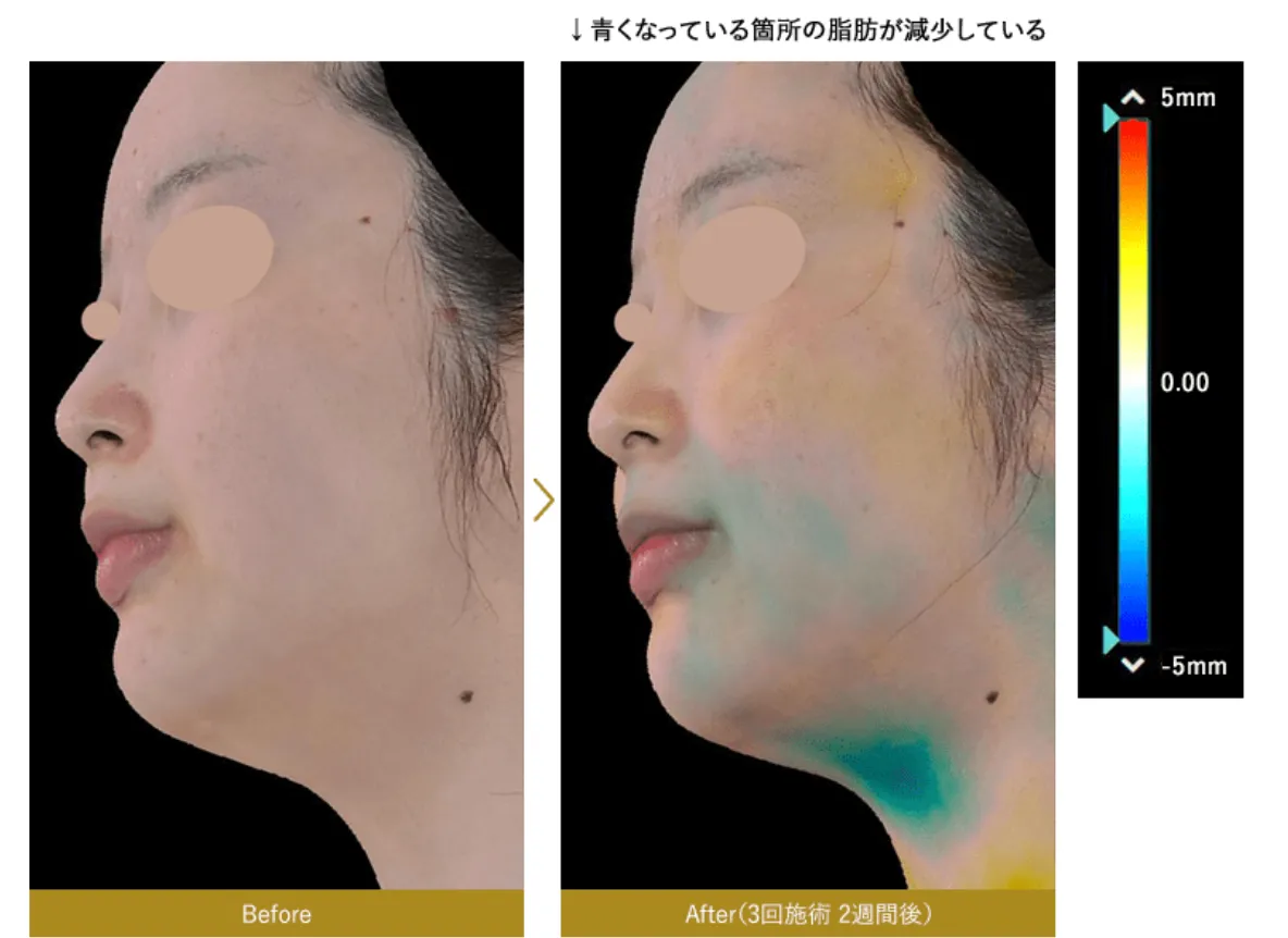 湘南美容クリニック(旧:湘南美容外科)の脂肪溶解リニアハイフの症例写真