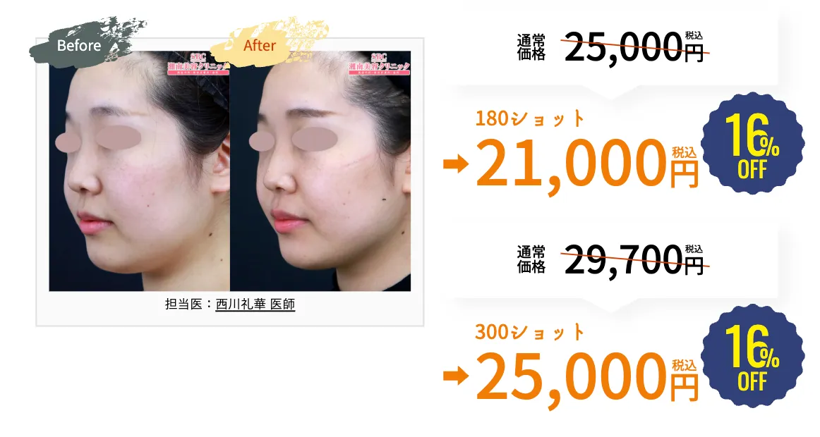 湘南美容クリニック(旧:湘南美容外科)の脂肪溶解リニアハイフのキャンペーン
