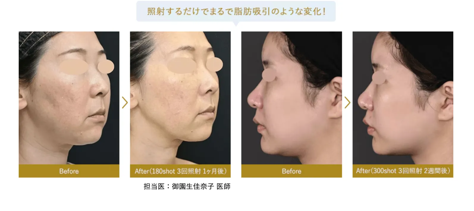 湘南美容クリニック(旧:湘南美容外科)の脂肪溶解リニアハイフの症例写真