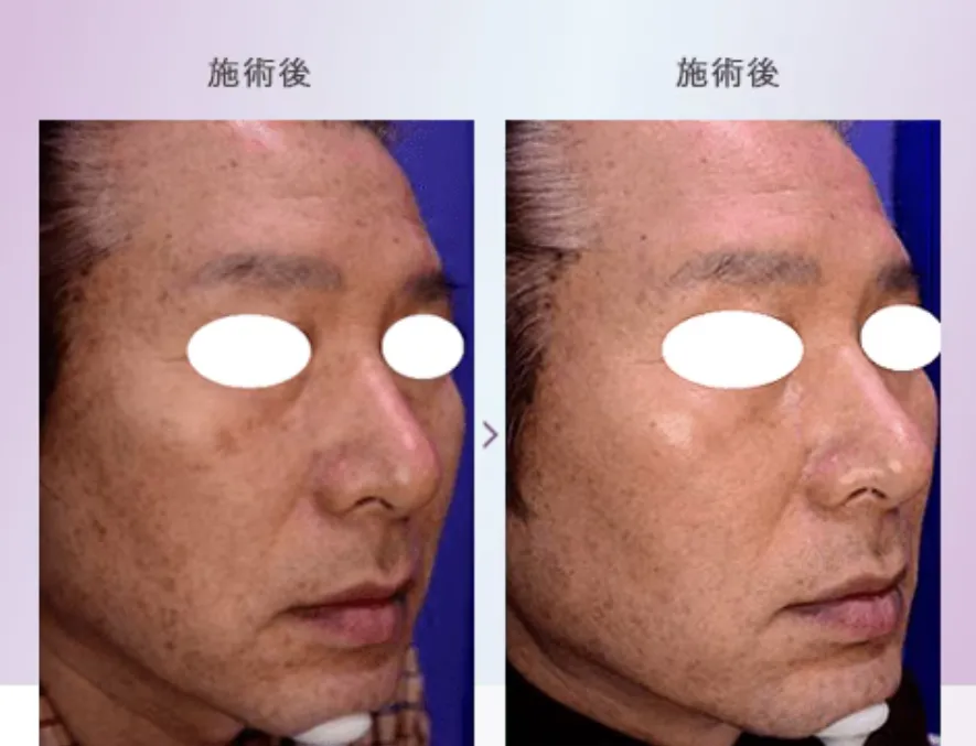 ピコフラクショナルを受けた方の症例その2