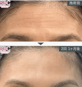 SBC女優注射症例①