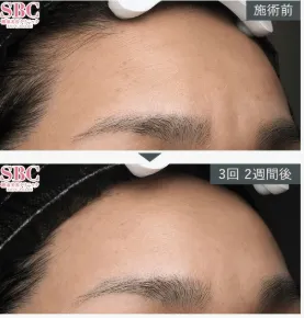SBC女優注射症例②