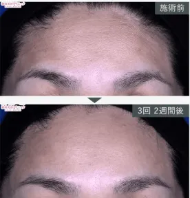 SBC女優注射症例③