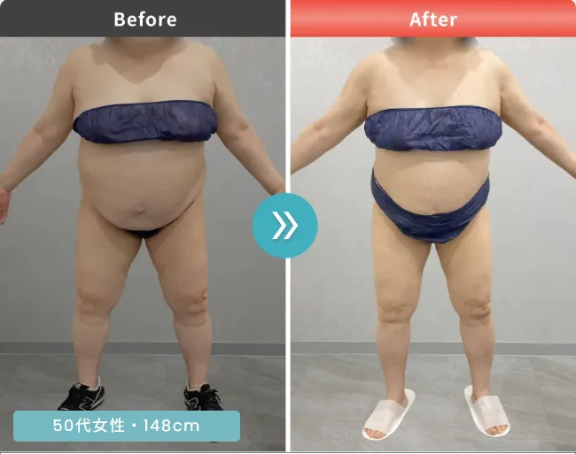 医療ダイエット症例③
