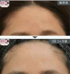 SBC女優注射症例④
