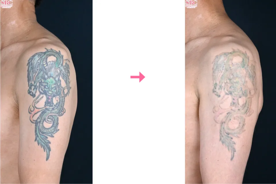 名古屋でタトゥー除去(刺青除去)が安いおすすめクリニックである湘南美容クリニックの症例①