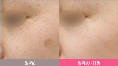 湘南美容クリニックのシミ取りキャンペーン症例①