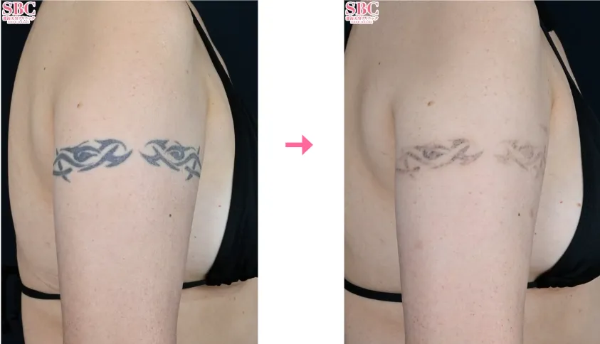 名古屋でタトゥー除去(刺青除去)が安いおすすめクリニックである湘南美容クリニックの症例②