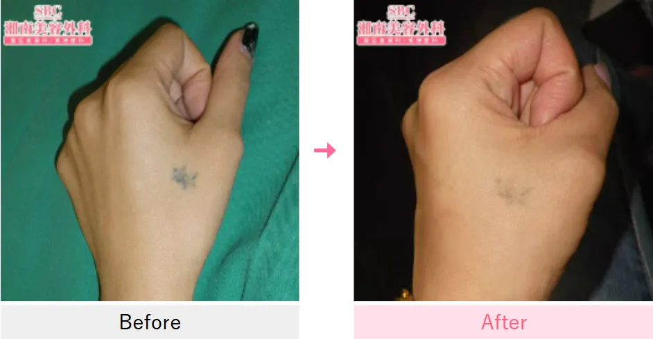 横浜でタトゥー除去(刺青除去)が安いおすすめクリニックである湘南美容クリニックの症例③