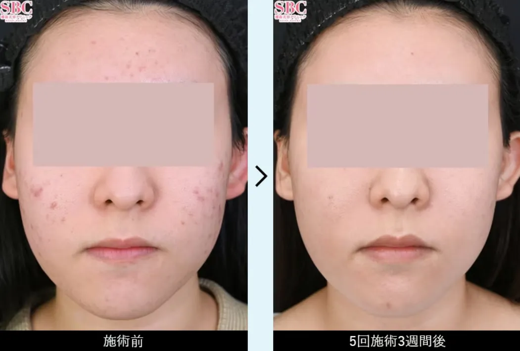 湘南美容クリニック(旧:湘南美容外科)のニキビ跡(アクネライト)の症例8
