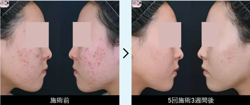 湘南美容クリニック(旧:湘南美容外科)のニキビ跡(アクネライト)の症例9