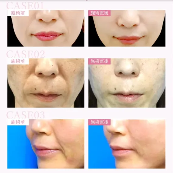 当記事がおすすめするTCBでヒアルロン酸注射を受けた方の症例写真