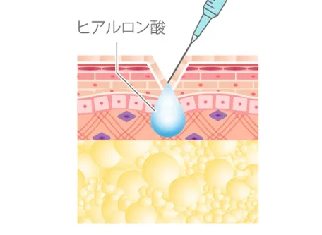 ヒアルロン酸注入時のイメージ画像