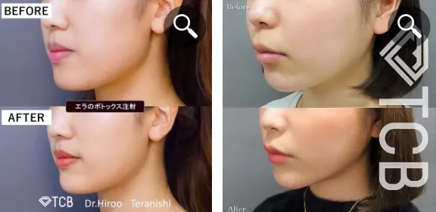 TCB エラボトックスの症例