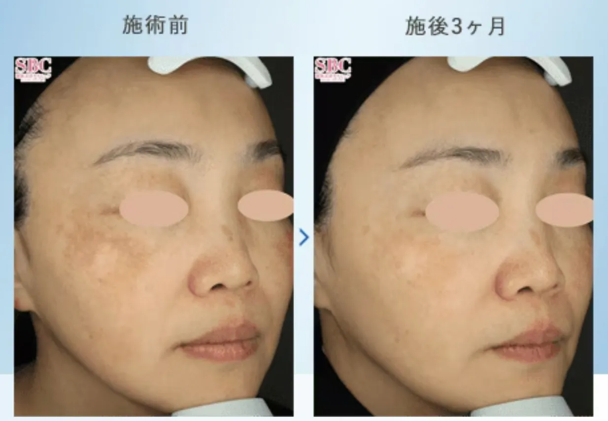 名古屋でピコトーニングが安いおすすめのクリニック湘南美容クリニック 症例写真