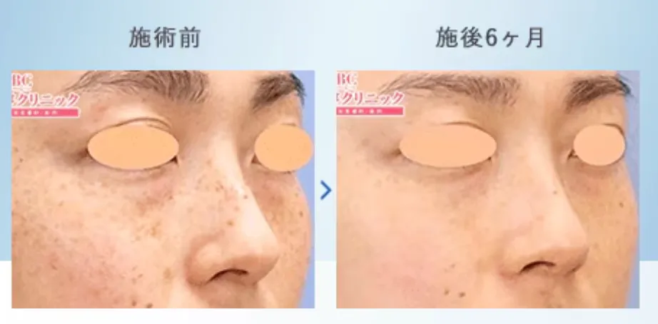 東京でピコトーニングが安いおすすめのクリニック湘南美容クリニック 症例写真