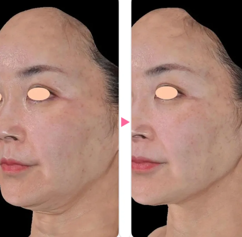 湘南美容クリニックのデンシティの症例