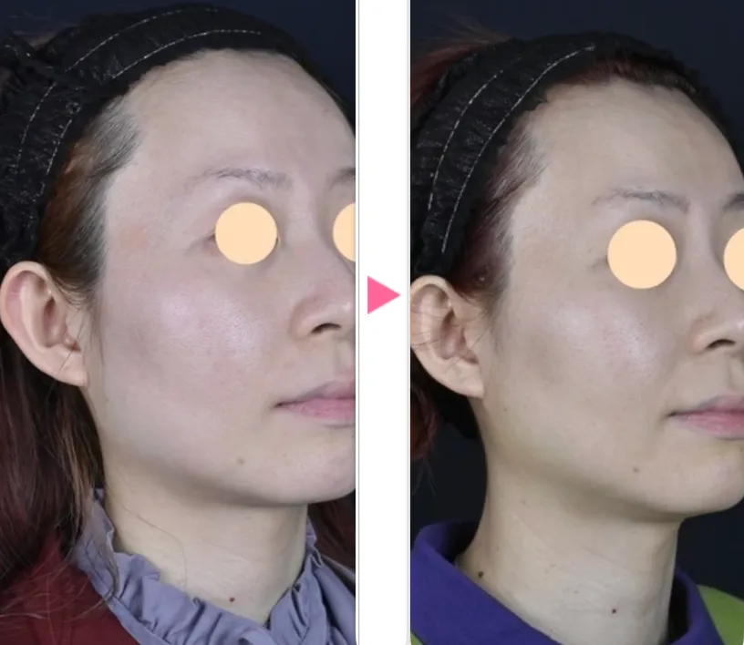 湘南美容クリニックのデンシティの症例