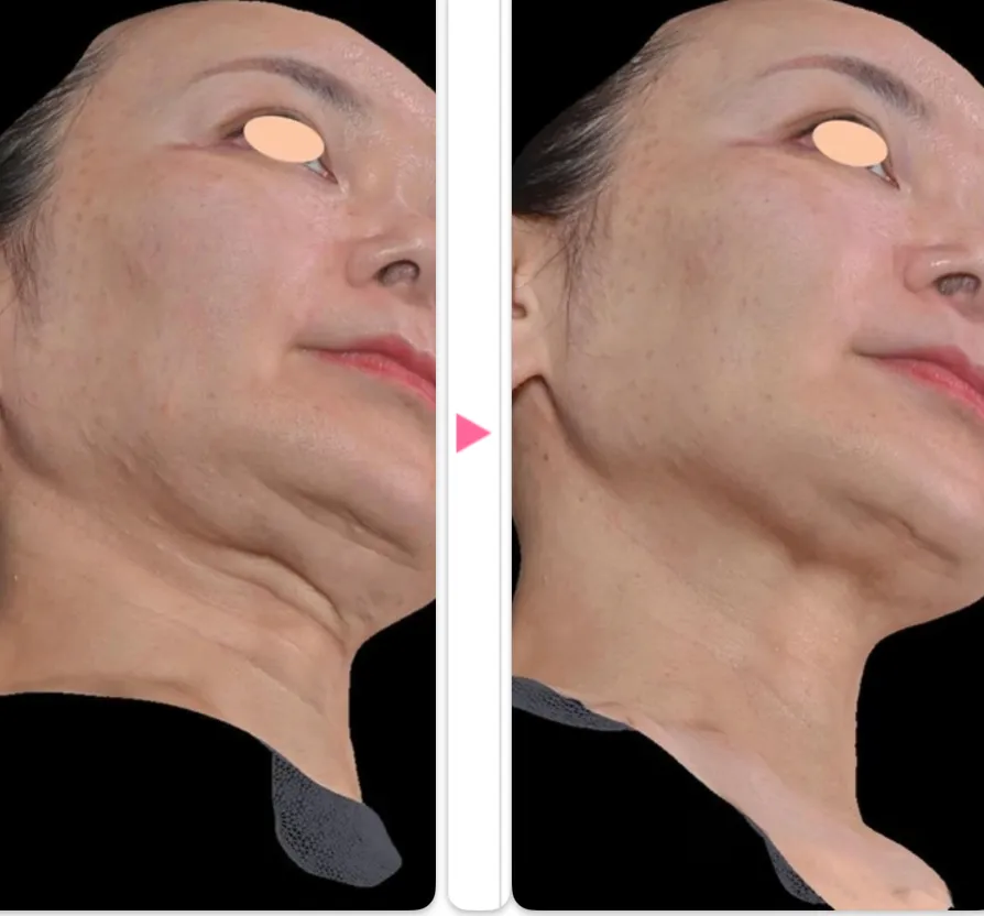 湘南美容クリニックのデンシティの症例