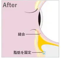 湘南美容クリニックの裏ハムラ法のイメージ画像