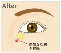 湘南美容クリニックの裏ハムラ法のイメージ画像