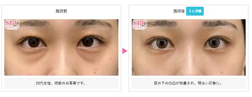 口コミ評判の良い湘南美容クリニックの裏ハムラ法の症例写真