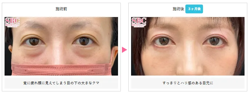 湘南美容クリニックの口コミ評判が良い裏ハムラ法の症例写真