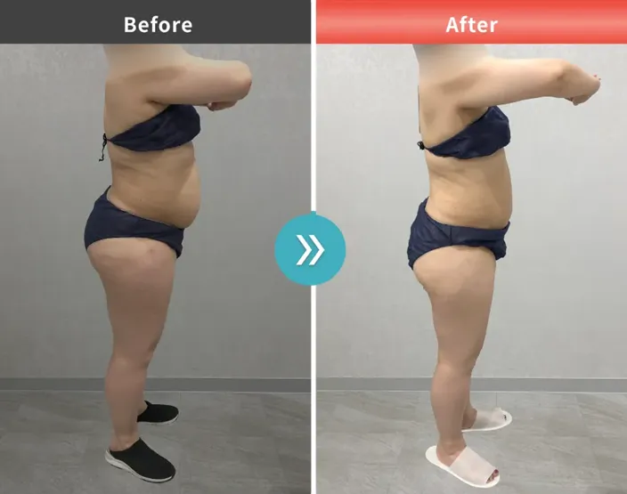 URARAクリニックオリジナルのプロテイン•効果高いって本当？専門家が徹底調査　症例写真②