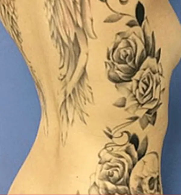 ピコレーザーの治療前