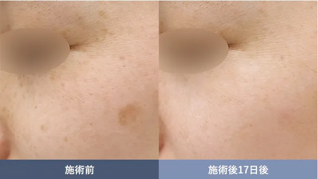 千葉でピコスポットが安いおすすめの湘南美容クリニックの症例写真