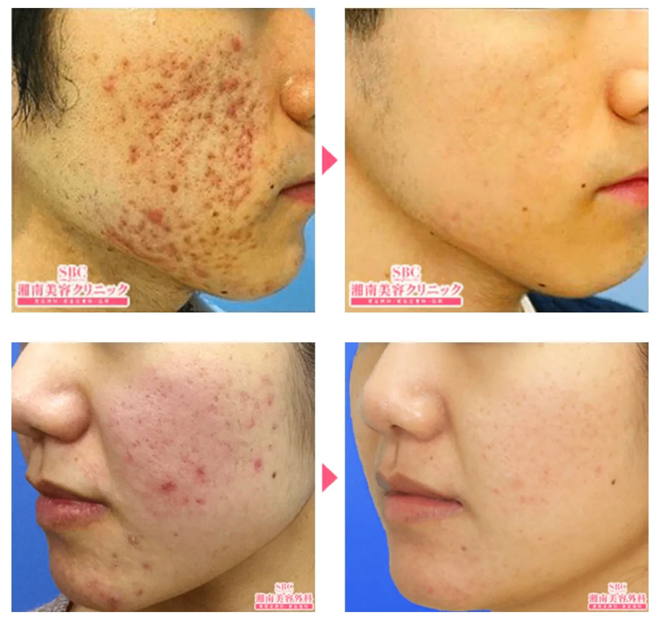 名古屋でおすすめの安いケミカルピーリングが受けられる湘南美容クリニックの症例写真