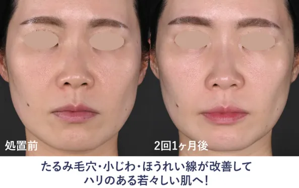 大阪でジャルプロスーパーハイドロが安いおすすめの湘南美容クリニックの症例写真