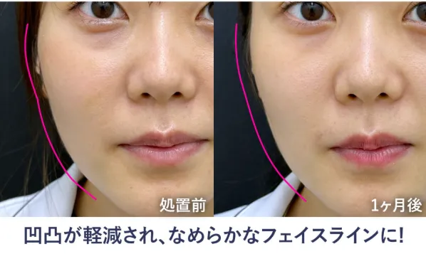神戸で安いとおすすめの湘南美容クリニックのジャルプロスーパーハイドロの症例写真